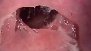 Anal Endoscope Rectum Camera inside